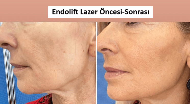 endolift nedir endolift öncesi sonrası