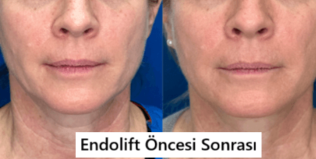 Endolift Nedir?
