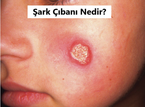 Şark Çıbanı (Cilt Leishmaniasisi) Nedir?