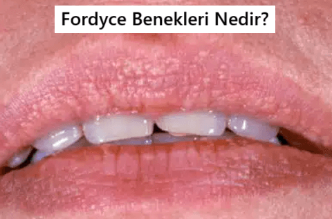 Fordyce Benekleri Nedir?