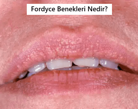 Fordyce Benekleri Nedir?