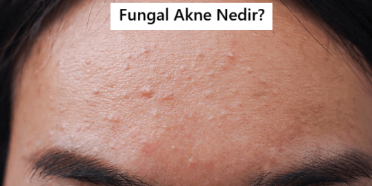 Fungal Akne Nedir? Nasıl Görünür?