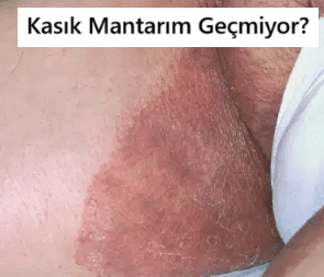 Geçmeyen Kasık Mantarı