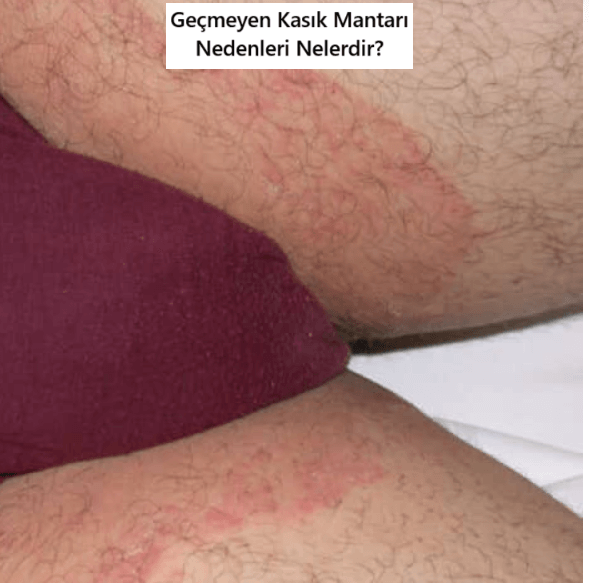 Geçmeyen Kasık Mantarı