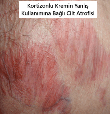 Kortizon krem yan etkileri
