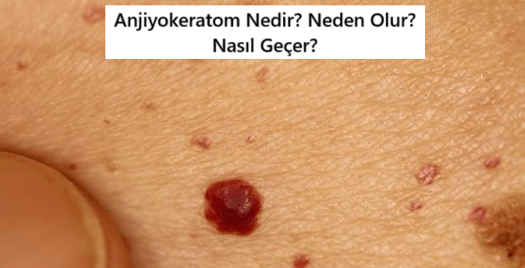 angiokeratoma nedir