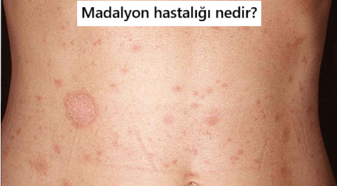 madalyon hastalığı görselleri