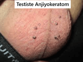 testiste angiokeratoma