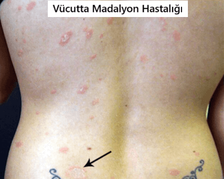 vücutta madalyon hastalığı